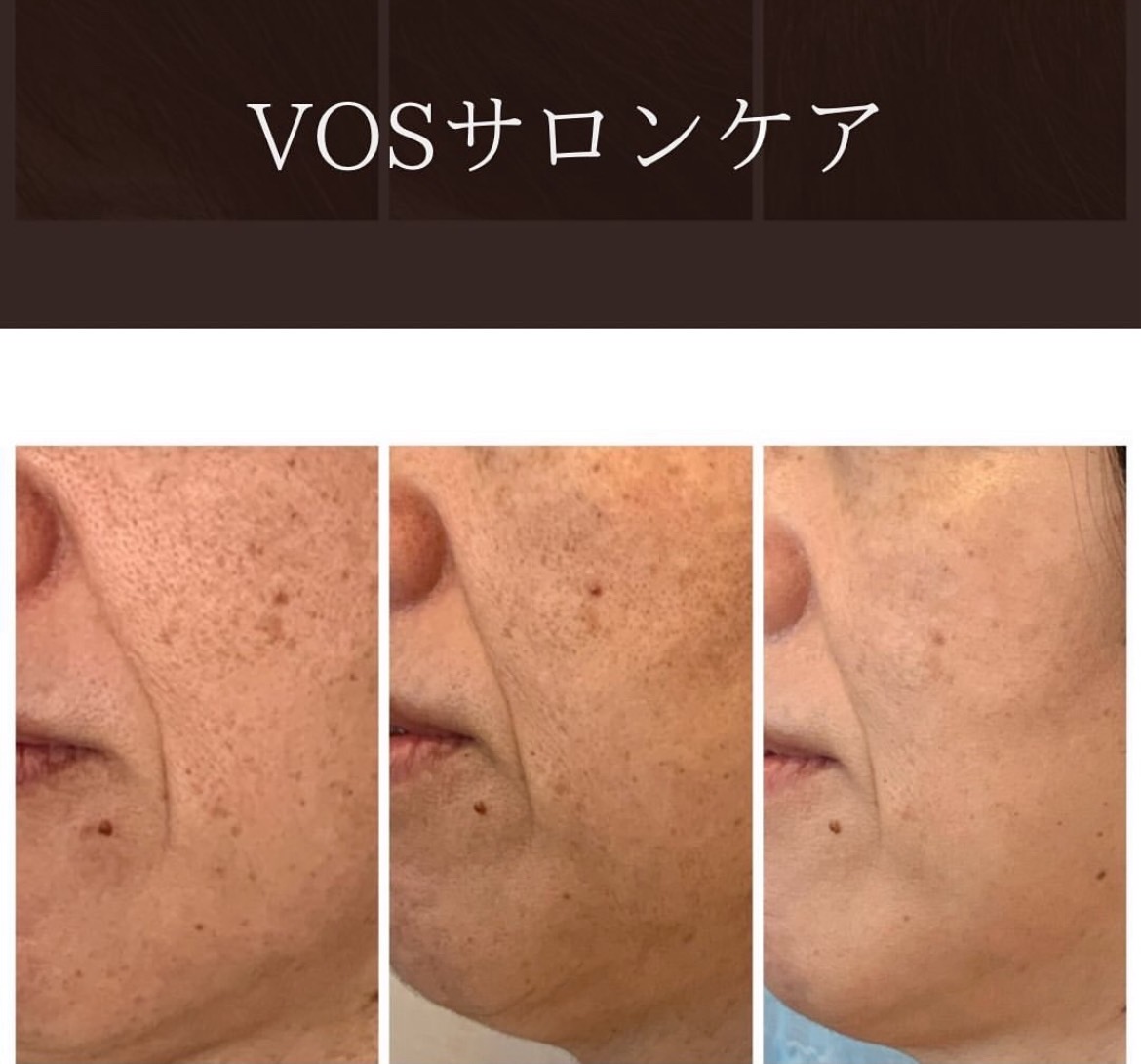 VOSサロンケアは美肌への近道 | フェィシャル＆ボディケアサロンフラウ